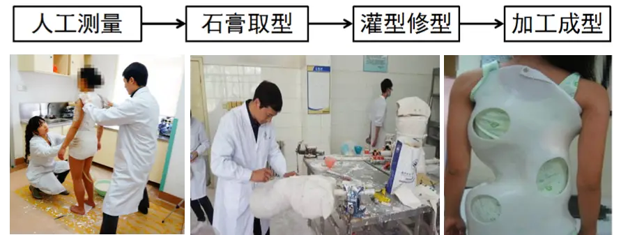 Complicated Production Process of Traditional Gypsum Spinal Orthosis, and Poor Experience for Patients.